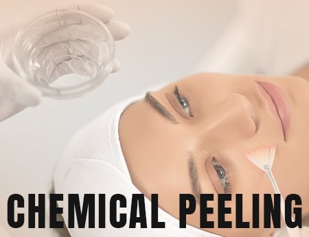 chemical peeling